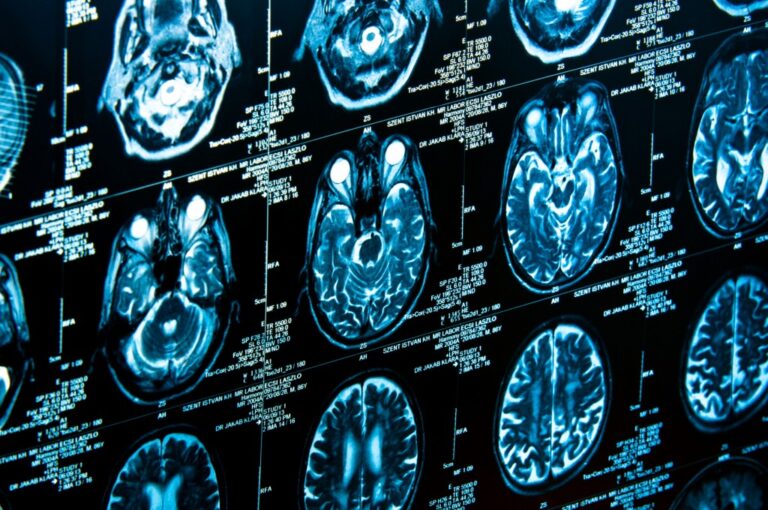 Effectiveness of Social Anxiety Therapy Can Be Predicted by Brain Scans